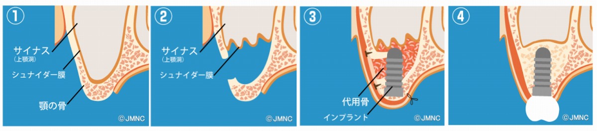 重度な骨の高さの不足を補う骨造成手術「サイナスリフト」