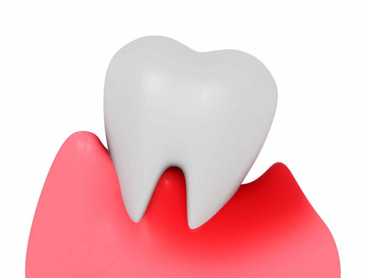 歯周病とは