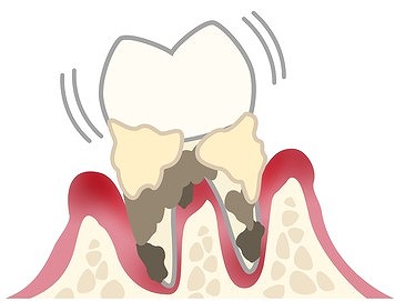 重度歯周病(歯槽膿漏)