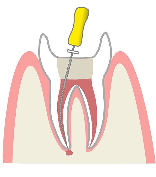 むし歯と神経の除去