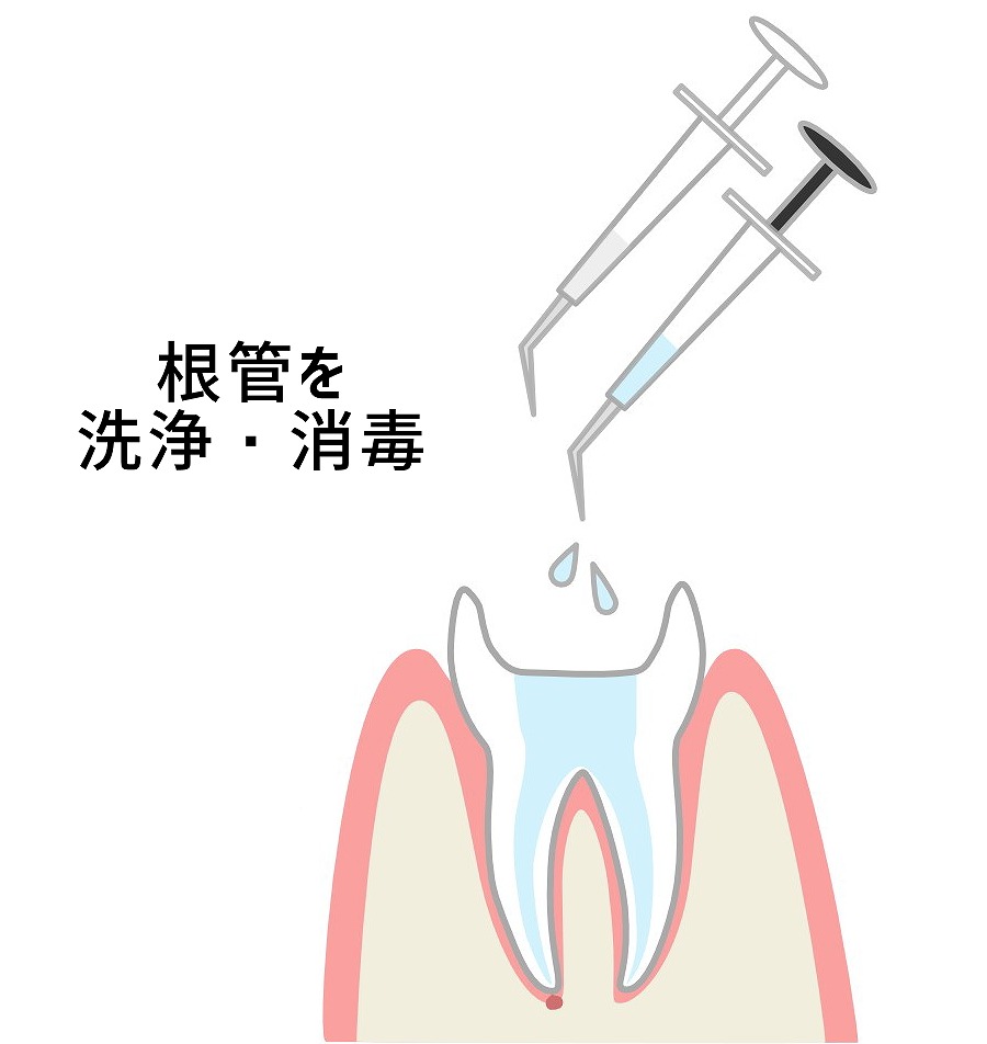 根管内の洗浄と消毒