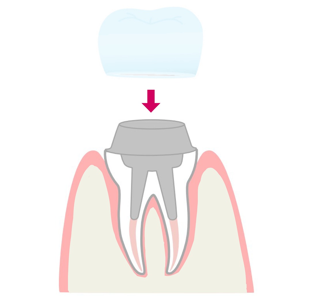 被せ物の装着